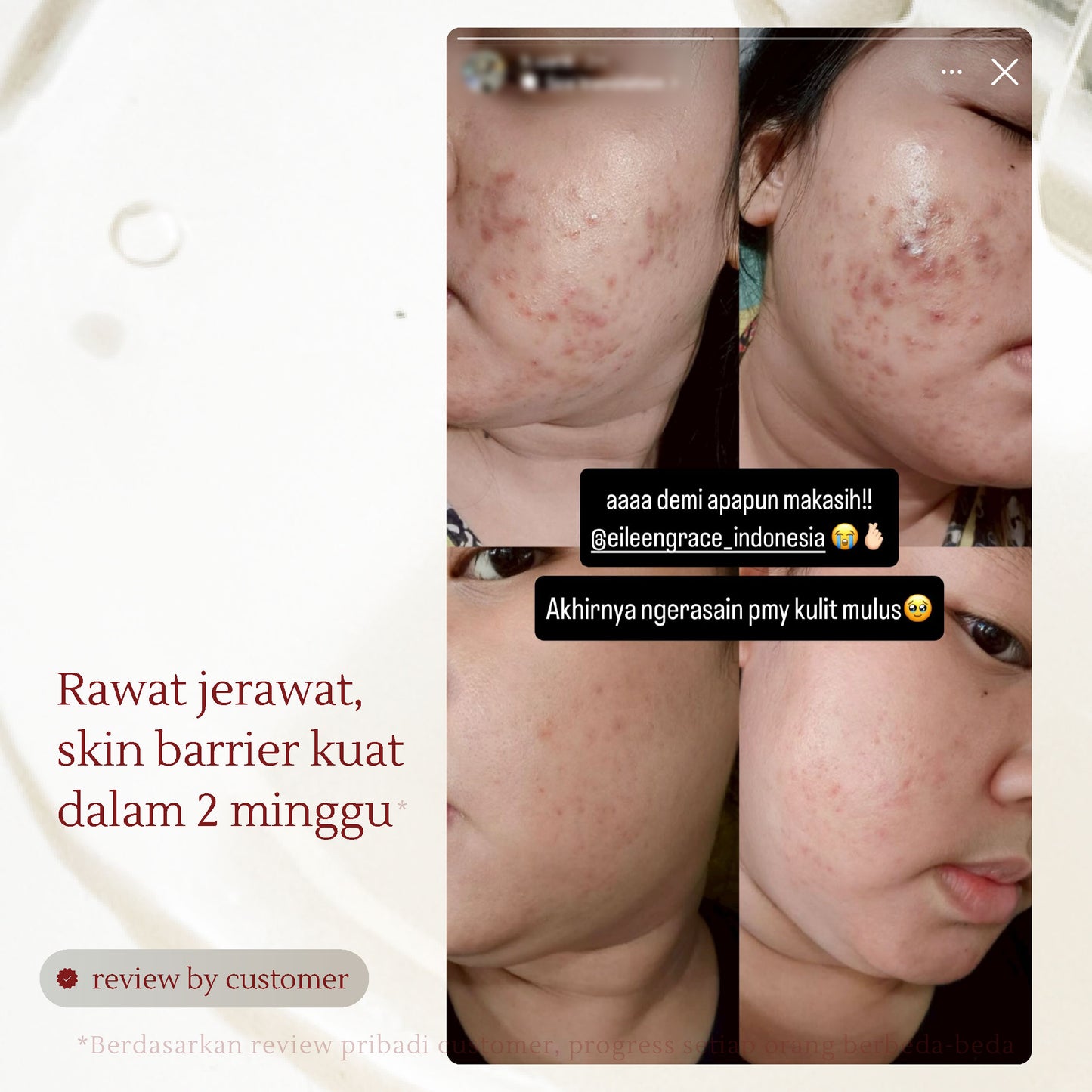 Active Acne Treatment Bundle | Rose Jelly Mask 300ml + Salicylic Acid Anti-Acne Foaming Cleanser + Salicylic Acid Acne Care Toner + Acne Care Essences