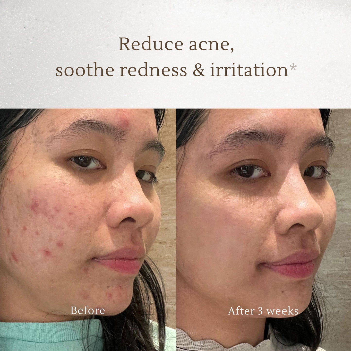 Face wash 3 in 1 Acne Cleansing Foam - 150ml | Pembersih Wajah | Facial Wash | Face Massage | Kulit Berjerawat | Kulit Iritasi | Kemerahan | Melembapkan | Hydrating | Jerawat | Salicylic Acid