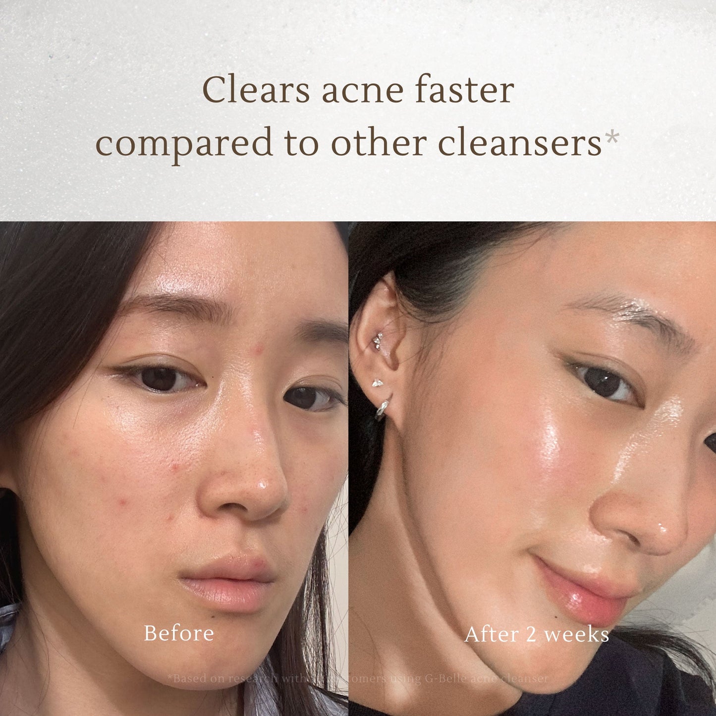 Face wash 3 in 1 Acne Cleansing Foam - 150ml | Pembersih Wajah | Facial Wash | Face Massage | Kulit Berjerawat | Kulit Iritasi | Kemerahan | Melembapkan | Hydrating | Jerawat | Salicylic Acid