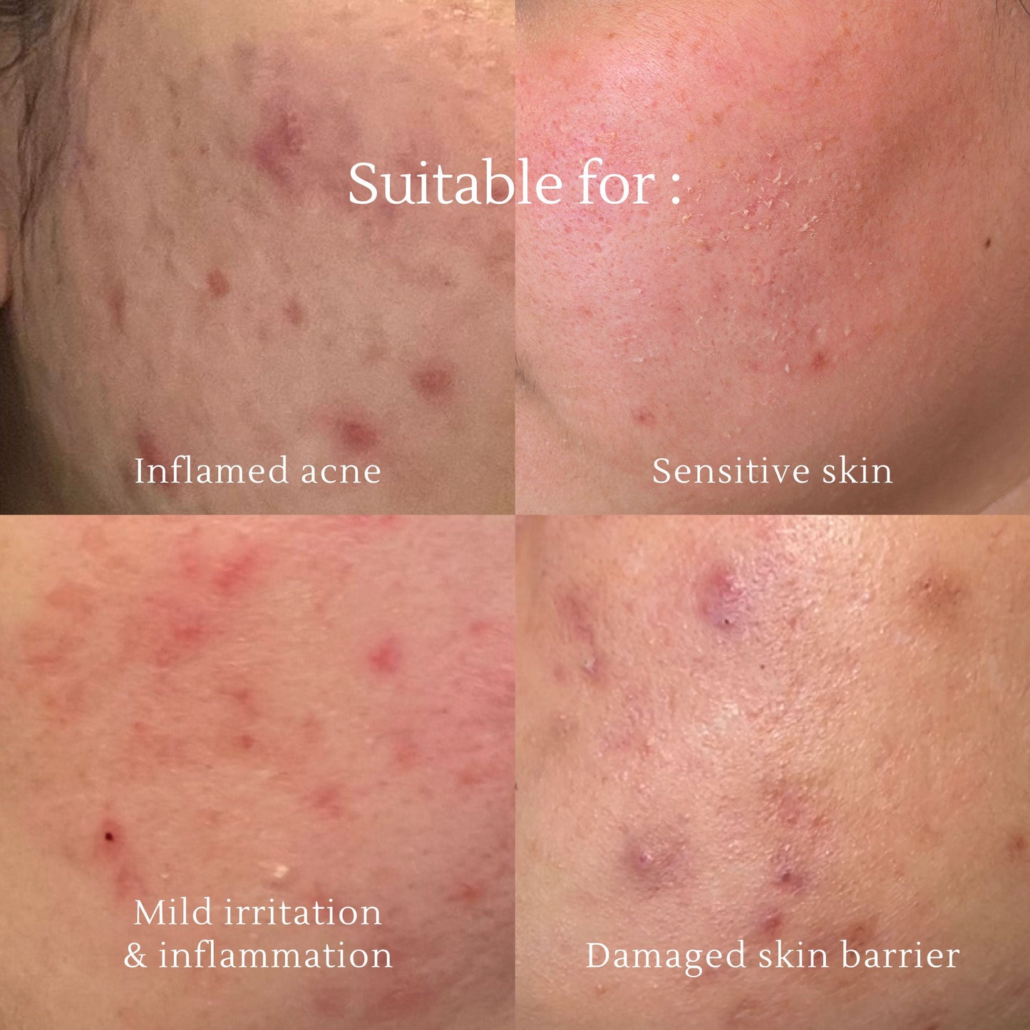 Face wash 3 in 1 Acne Cleansing Foam - 150ml | Pembersih Wajah | Facial Wash | Face Massage | Kulit Berjerawat | Kulit Iritasi | Kemerahan | Melembapkan | Hydrating | Jerawat | Salicylic Acid