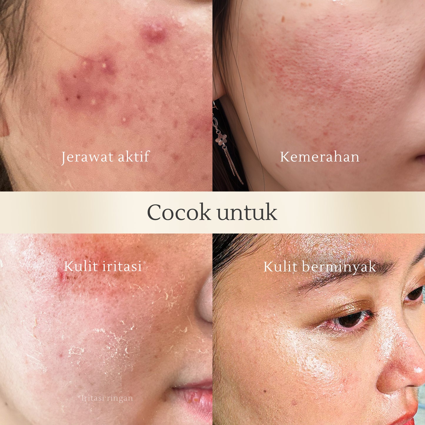 Acne Skin Balancing Toner 120 ml | Kulit Berminyak | Jerawat | Kemerahan | Oily Skin | Kulit Sensitif | Alcohol Free | Fragrance Free