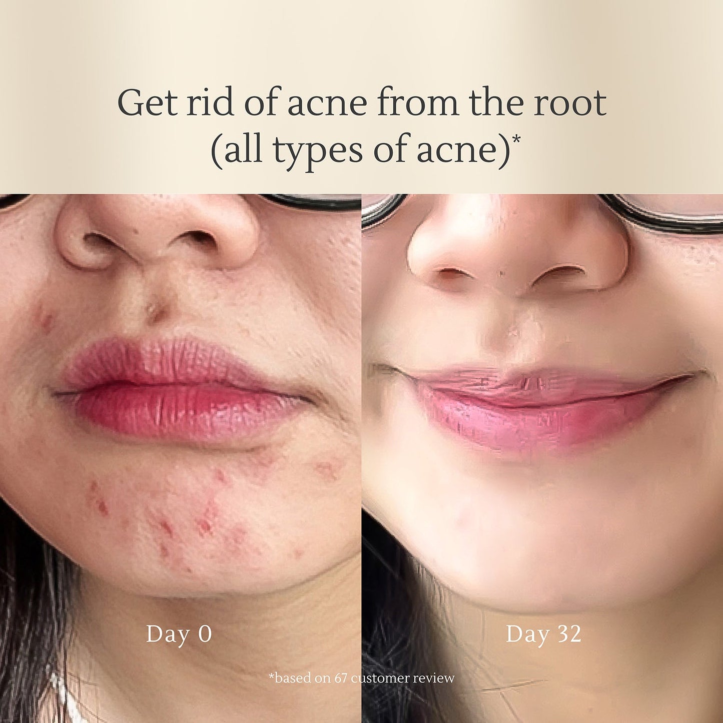 Acne Serum 50g | Jerawat | Bekas Jerawat PIE | Kemerahan | Kulit Sensitif | Alcohol Free | Fragrance Free