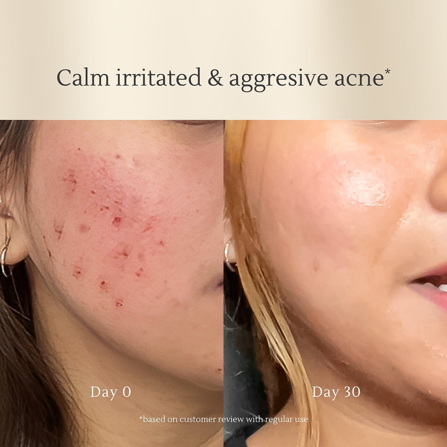 Acne Serum 50g | Jerawat | Bekas Jerawat PIE | Kemerahan | Kulit Sensitif | Alcohol Free | Fragrance Free