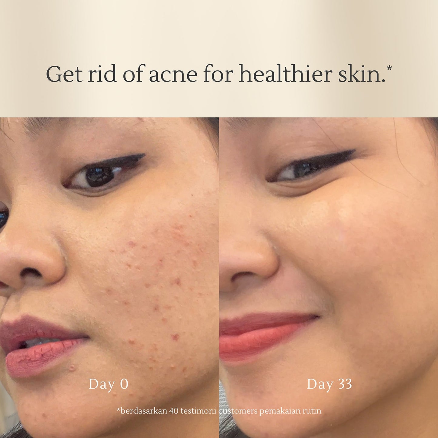 Acne Cleansing Cream 100g | Jerawat | Oily Skin | Kulit Sensitif | Alcohol Free | Fragrance Free | Facial Wash