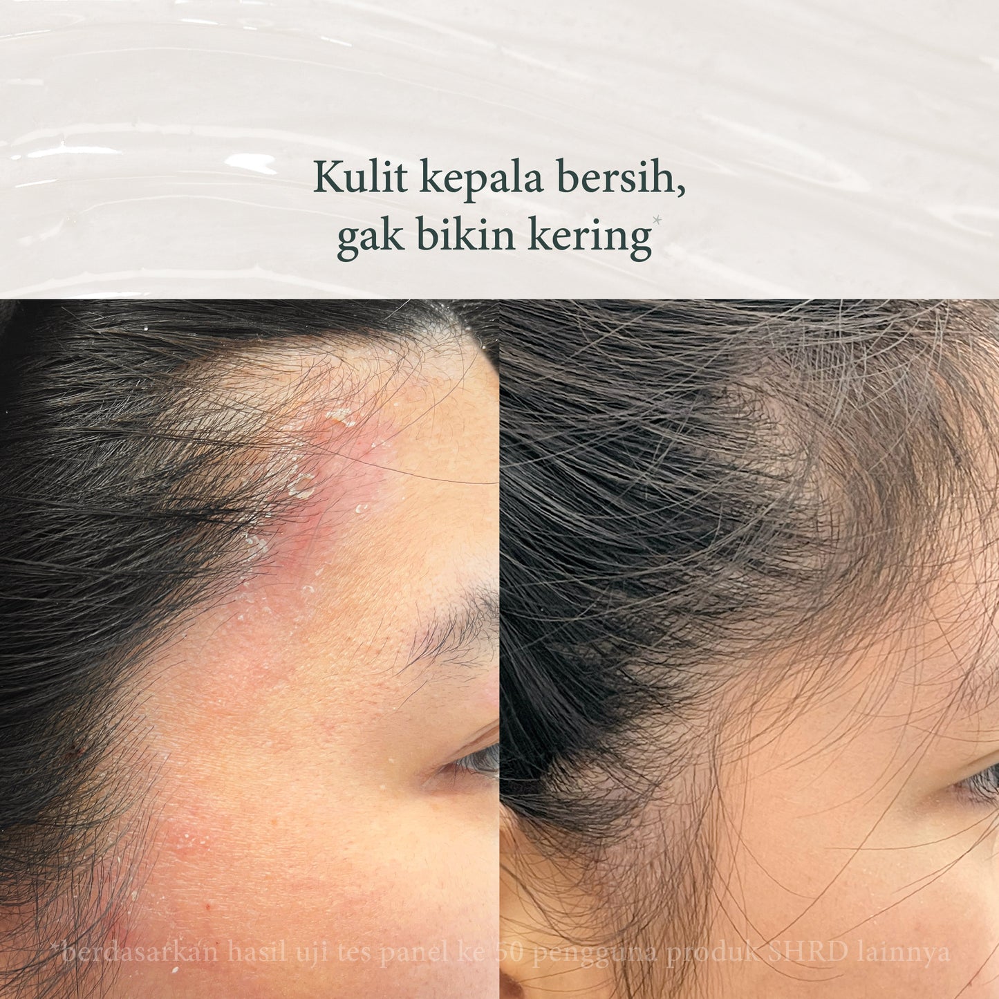 Tea Tree | shampoo anti ketombe | Perawatan Rambut | Gatal | Ketombe | Ketombe kering | Kering | Sensitive Scalp | Haircare