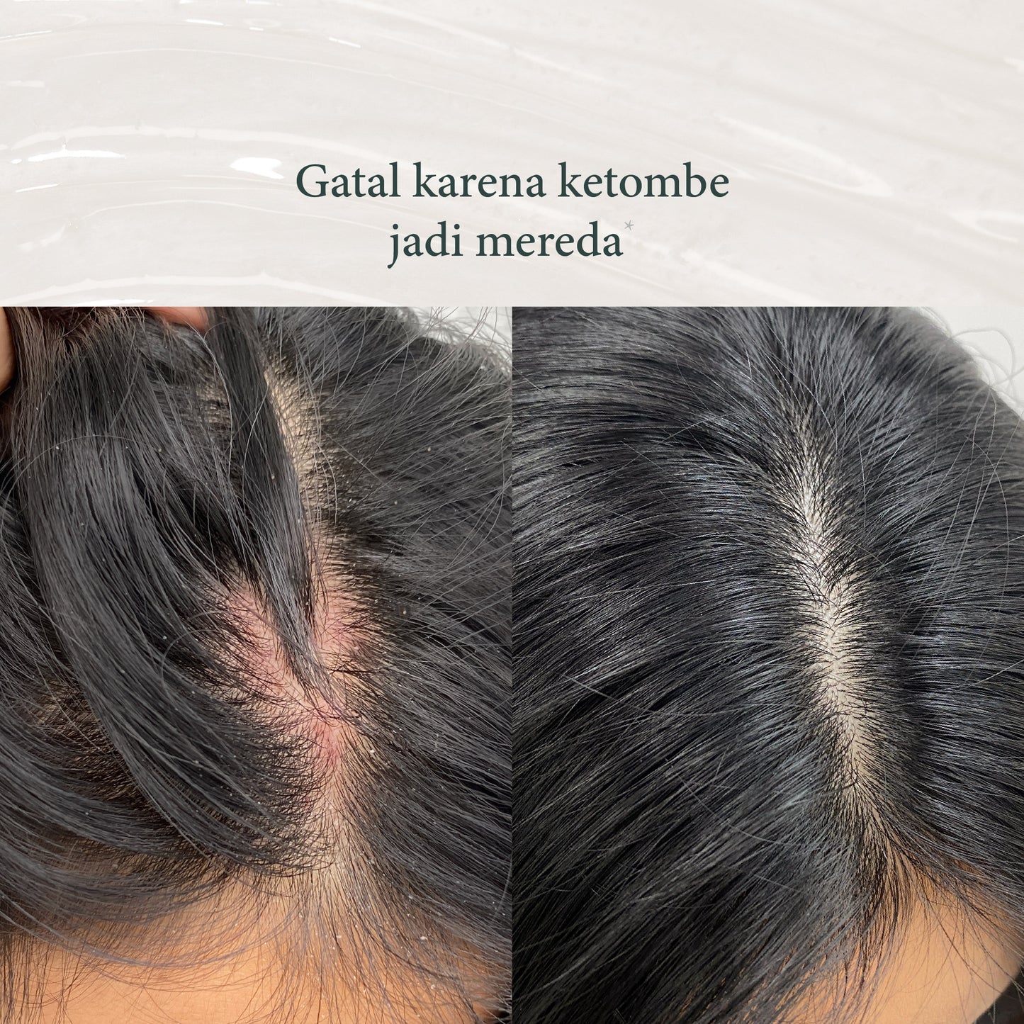 Tea Tree | shampoo anti ketombe | Perawatan Rambut | Gatal | Ketombe | Ketombe kering | Kering | Sensitive Scalp | Haircare