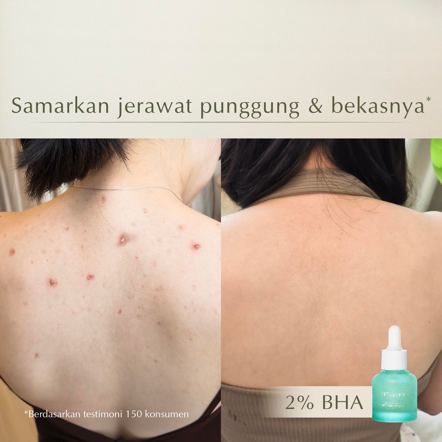 2% Salicylic Acne Solution Serum | Anti jerawat | Meredakan Jerawat | Salicylic Acid | Niacinamide | Serum Jerawat | Gentle Exfoliator | Mengurangi kemerahan | Membersihkan Pori | Mencerahkan kulit kusam |  Menenangkan kulit sensitif