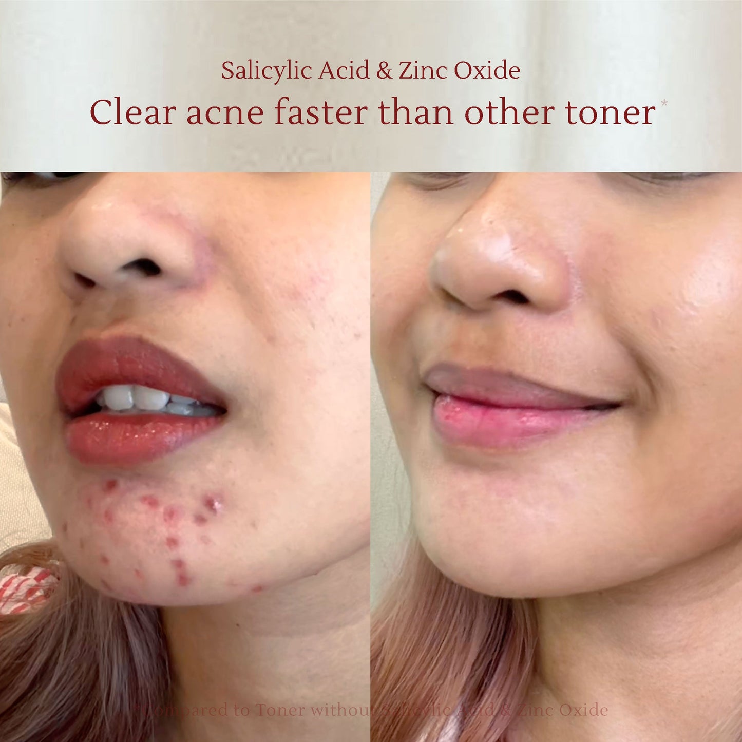 Salicylic Acid Acne Care Toner 120 ml | Kulit kusam berminyak | Kulit sensitif | Dark spot & noda hitam | Bekas jerawat hitam |  Jerawat | Kemerahan | Oil Control | Flek hitam | Hiperpigmentasi | Zinc oxide | Tea Tree