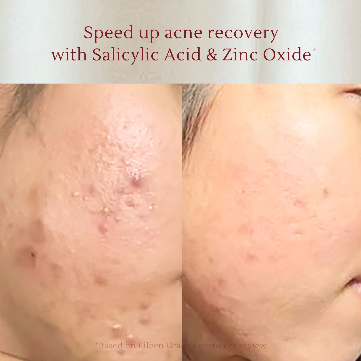 Salicylic Acid Acne Care Toner 120 ml | Kulit kusam berminyak | Kulit sensitif | Dark spot & noda hitam | Bekas jerawat hitam |  Jerawat | Kemerahan | Oil Control | Flek hitam | Hiperpigmentasi | Zinc oxide | Tea Tree