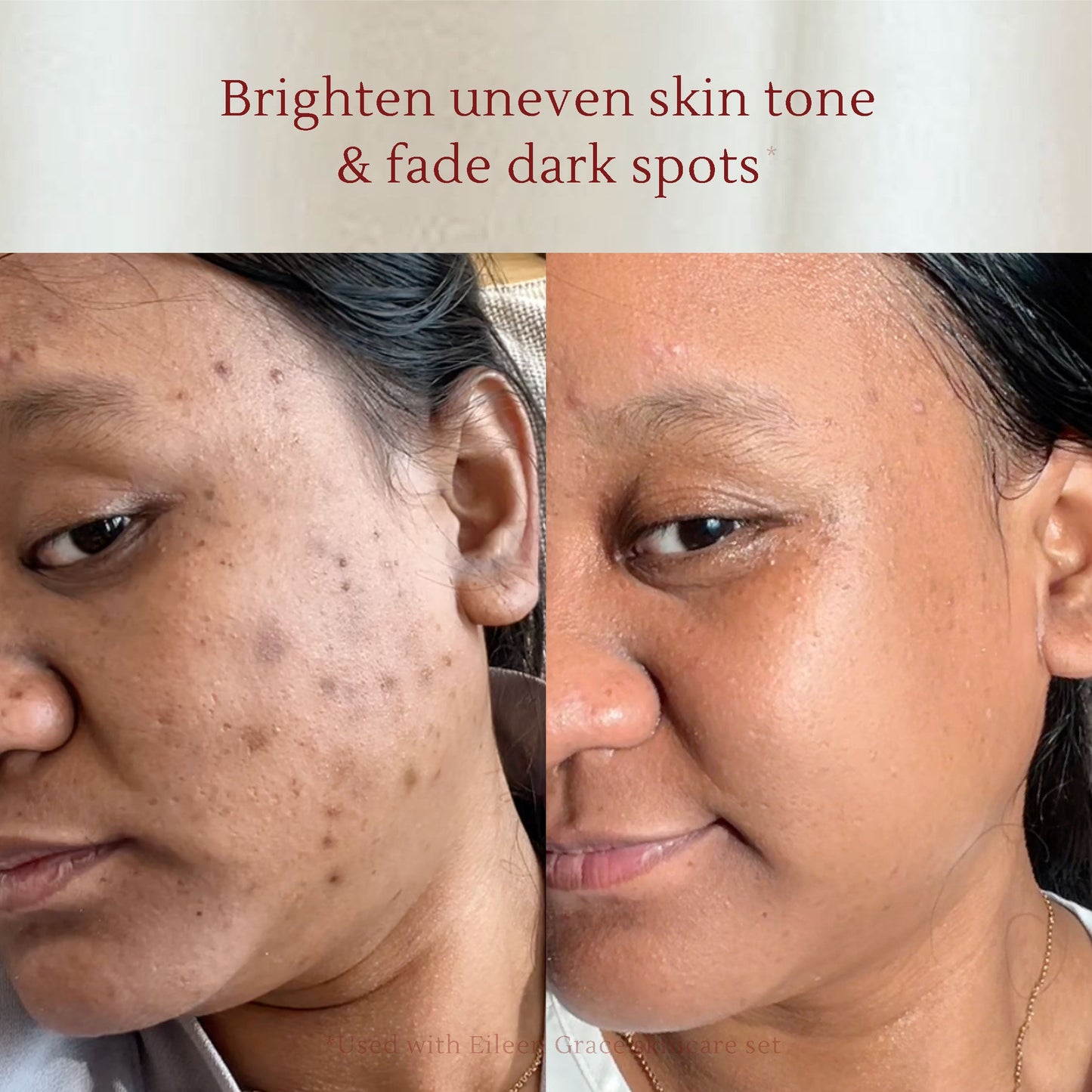 Salicylic Acid Acne Care Toner 120 ml | Kulit kusam berminyak | Kulit sensitif | Dark spot & noda hitam | Bekas jerawat hitam |  Jerawat | Kemerahan | Oil Control | Flek hitam | Hiperpigmentasi | Zinc oxide | Tea Tree