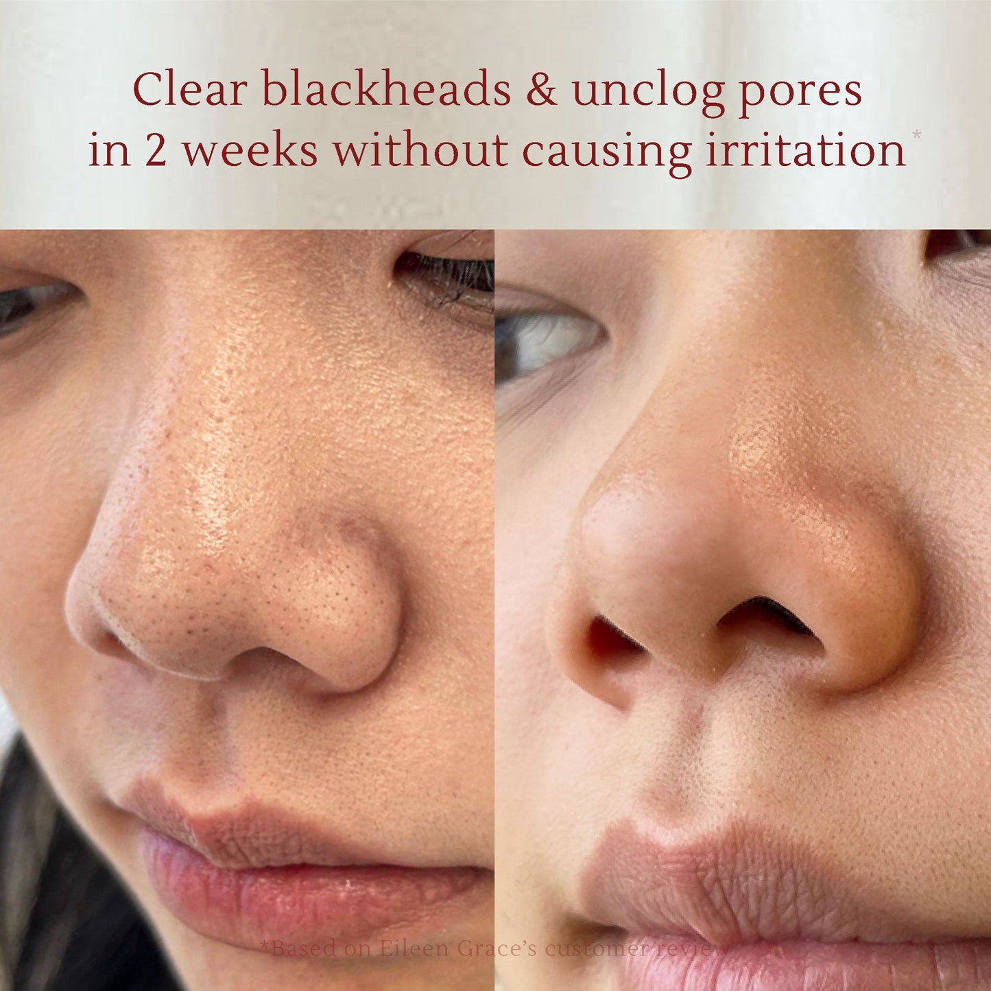 Salicylic Acid Anti-Acne Foaming Cleanser 150 ml | Face / Facial wash | Kulit berminyak sensitif | Komedo | Pori besar | Blackhead & Whitehead | Gentle exfoliation | Oil Control | Jerawat | Salicylic acid BHA | Tea tree