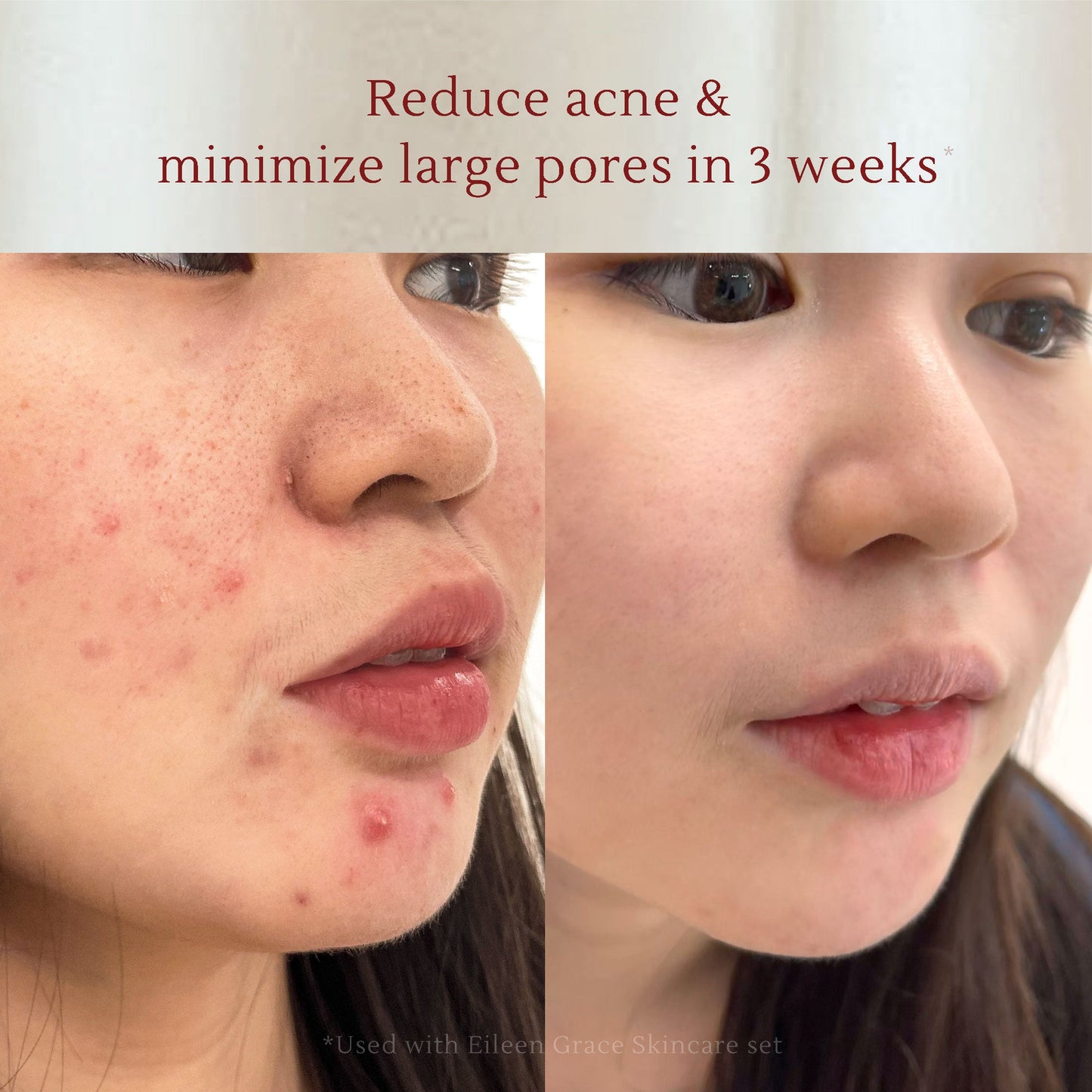 Salicylic Acid Anti-Acne Foaming Cleanser 150 ml | Face / Facial wash | Kulit berminyak sensitif | Komedo | Pori besar | Blackhead & Whitehead | Gentle exfoliation | Oil Control | Jerawat | Salicylic acid BHA | Tea tree