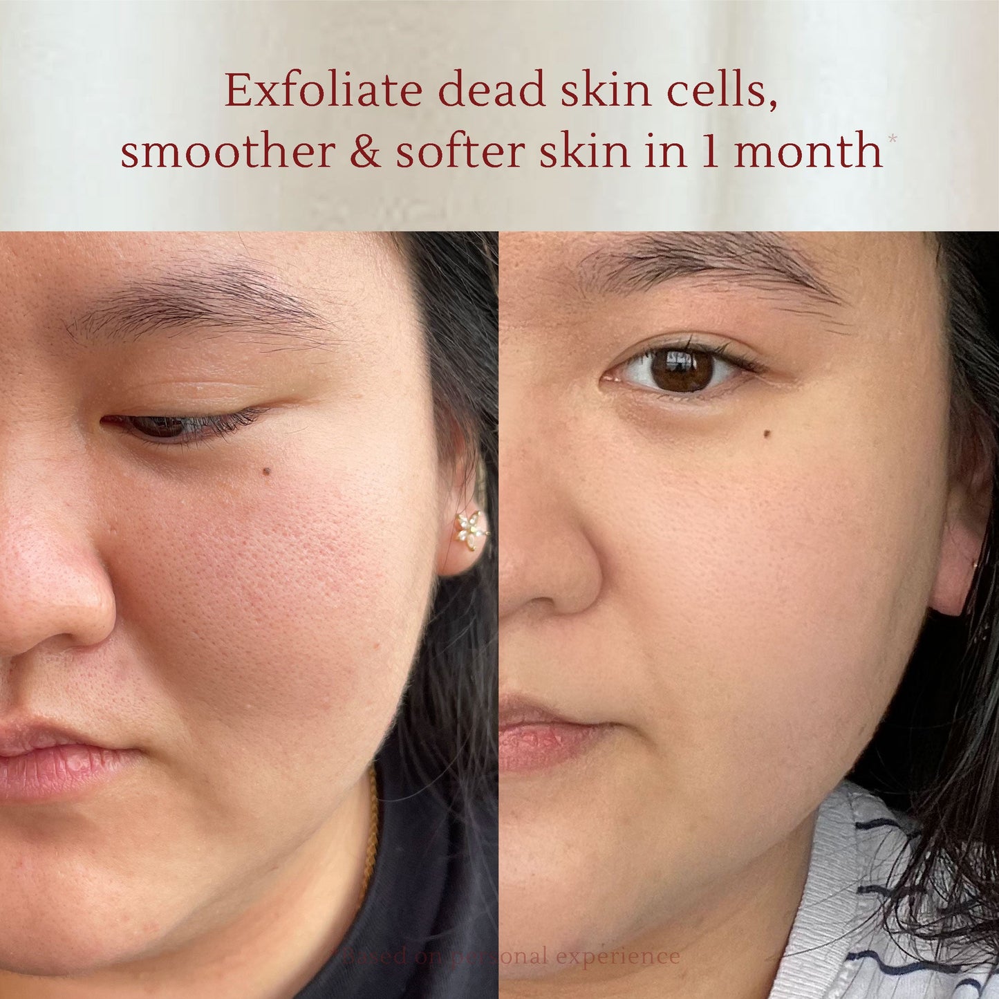 Salicylic Acid Anti-Acne Foaming Cleanser 150 ml | Face / Facial wash | Kulit berminyak sensitif | Komedo | Pori besar | Blackhead & Whitehead | Gentle exfoliation | Oil Control | Jerawat | Salicylic acid BHA | Tea tree