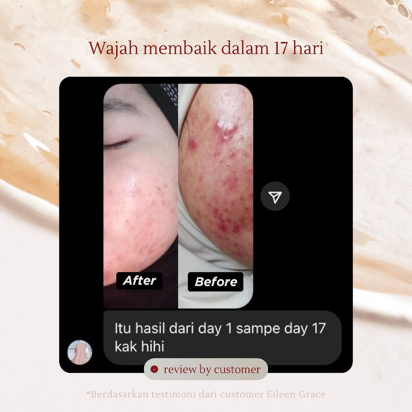 Active Acne Treatment Bundle | Rose Jelly Mask 300ml + Salicylic Acid Anti-Acne Foaming Cleanser + Salicylic Acid Acne Care Toner + Acne Care Essences