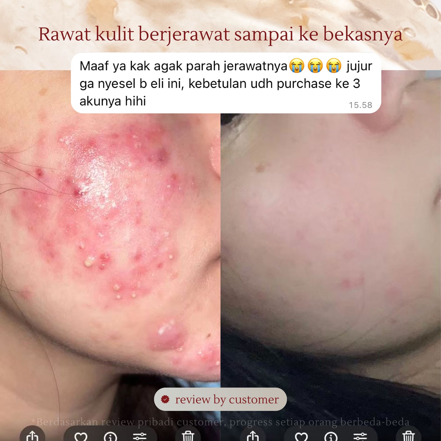 Active Acne Treatment Bundle | Rose Jelly Mask 300ml + Salicylic Acid Anti-Acne Foaming Cleanser + Salicylic Acid Acne Care Toner + Acne Care Essences