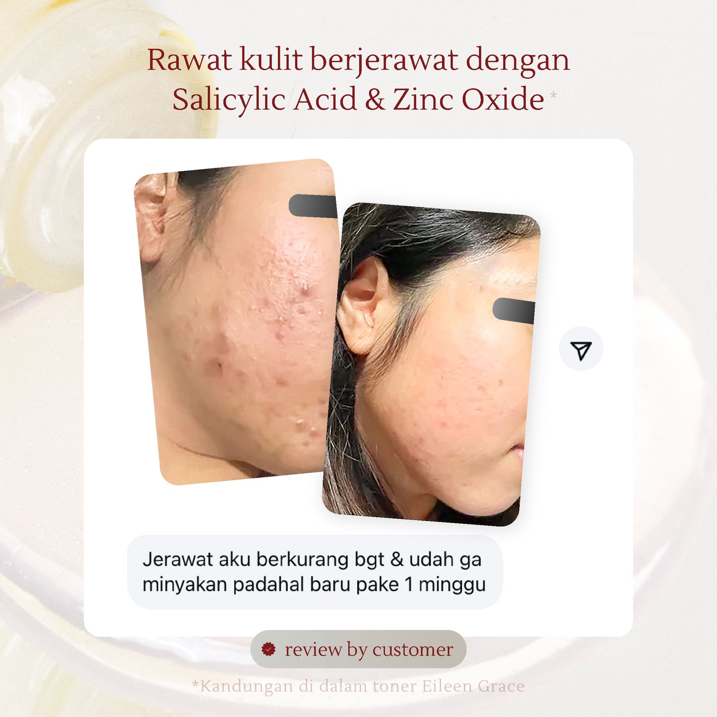 Active Acne Treatment Bundle | Rose Jelly Mask 300ml + Salicylic Acid Anti-Acne Foaming Cleanser + Salicylic Acid Acne Care Toner + Acne Care Essences