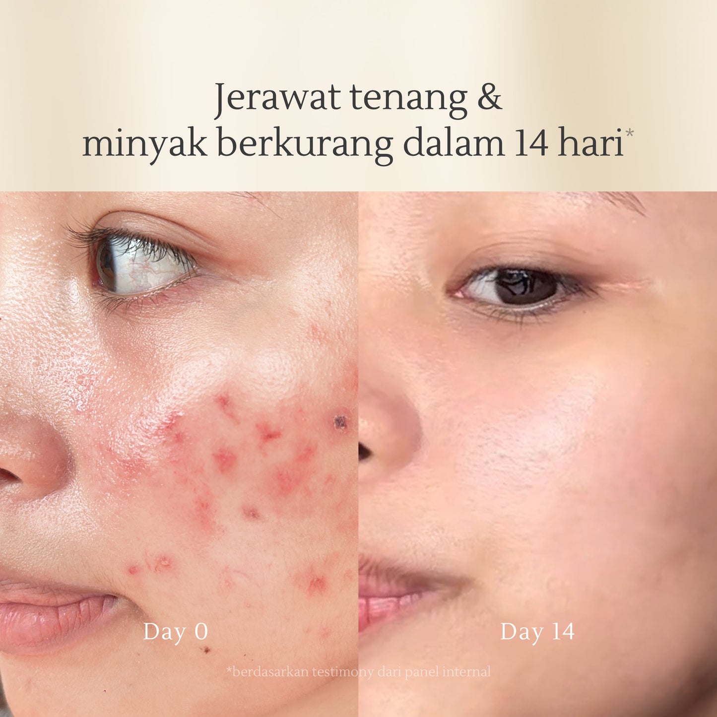 Acne Skin Balancing Toner 120 ml | Kulit Berminyak | Jerawat | Kemerahan | Oily Skin | Kulit Sensitif | Alcohol Free | Fragrance Free