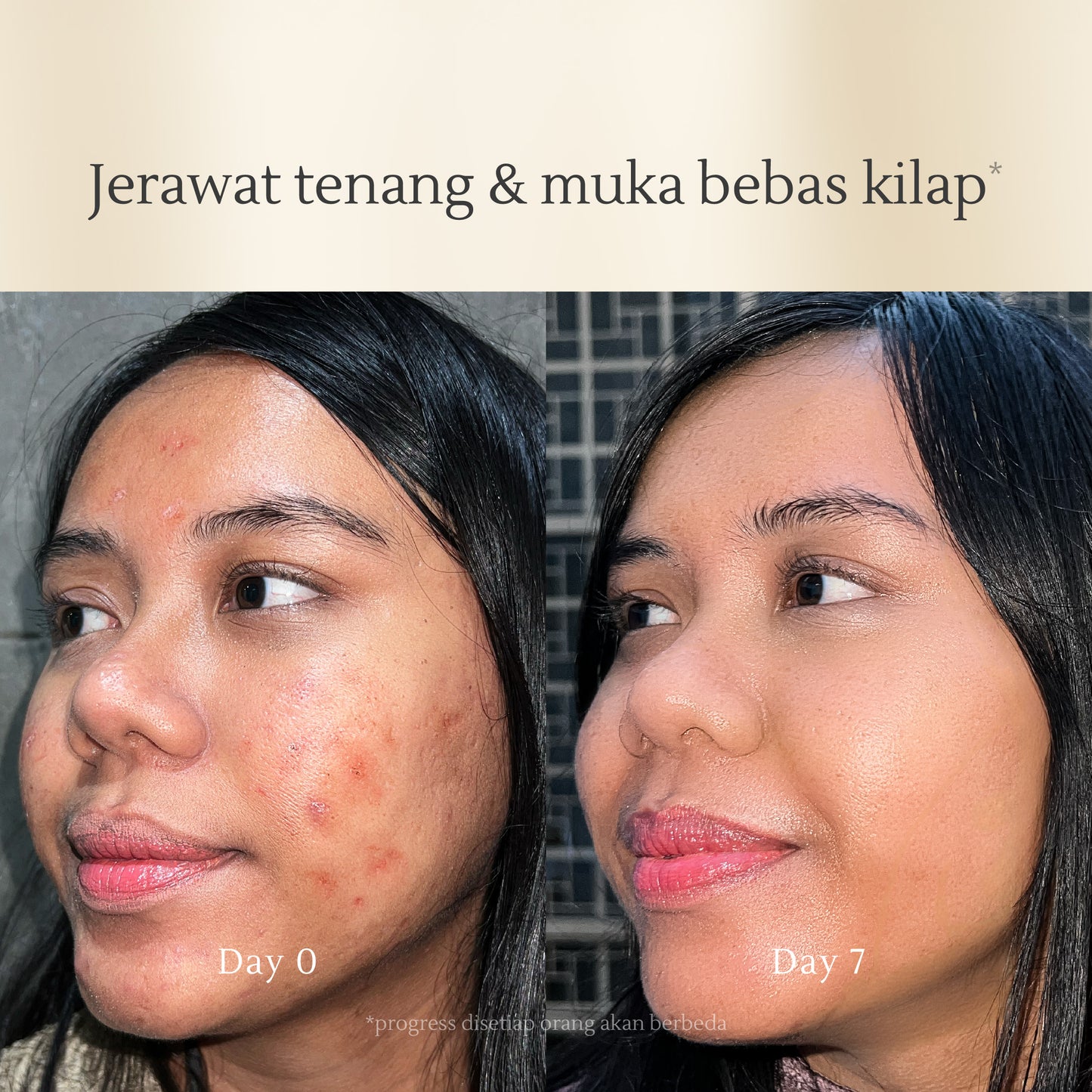 Acne Skin Balancing Toner 120 ml | Kulit Berminyak | Jerawat | Kemerahan | Oily Skin | Kulit Sensitif | Alcohol Free | Fragrance Free