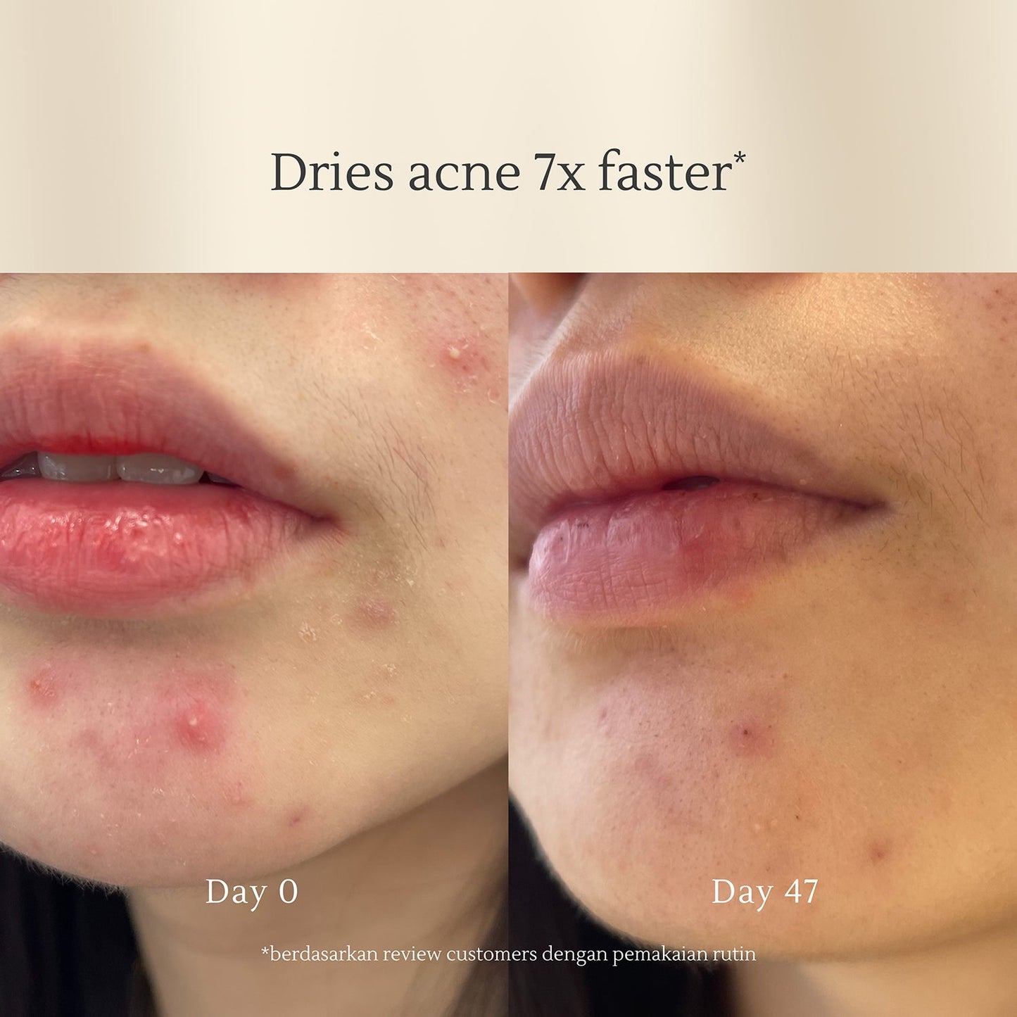 Acne Cleansing Cream 100g | Jerawat | Oily Skin | Kulit Sensitif | Alcohol Free | Fragrance Free | Facial Wash