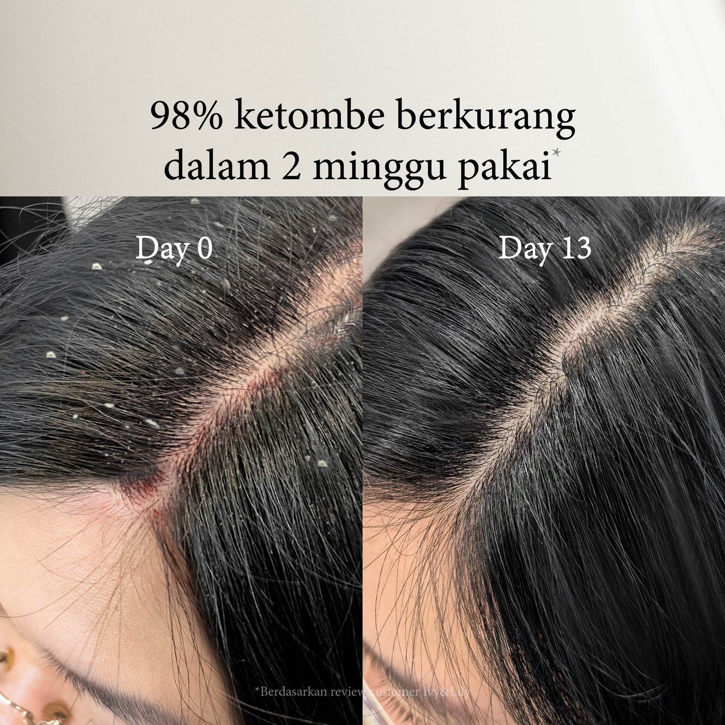Ocean Breeze Dandruff Treatment Shampoo | Perawatan Rambut | Gatal | Ketombe Basah | Ketombe kering | Kering | Sensitive Scalp | Haircare