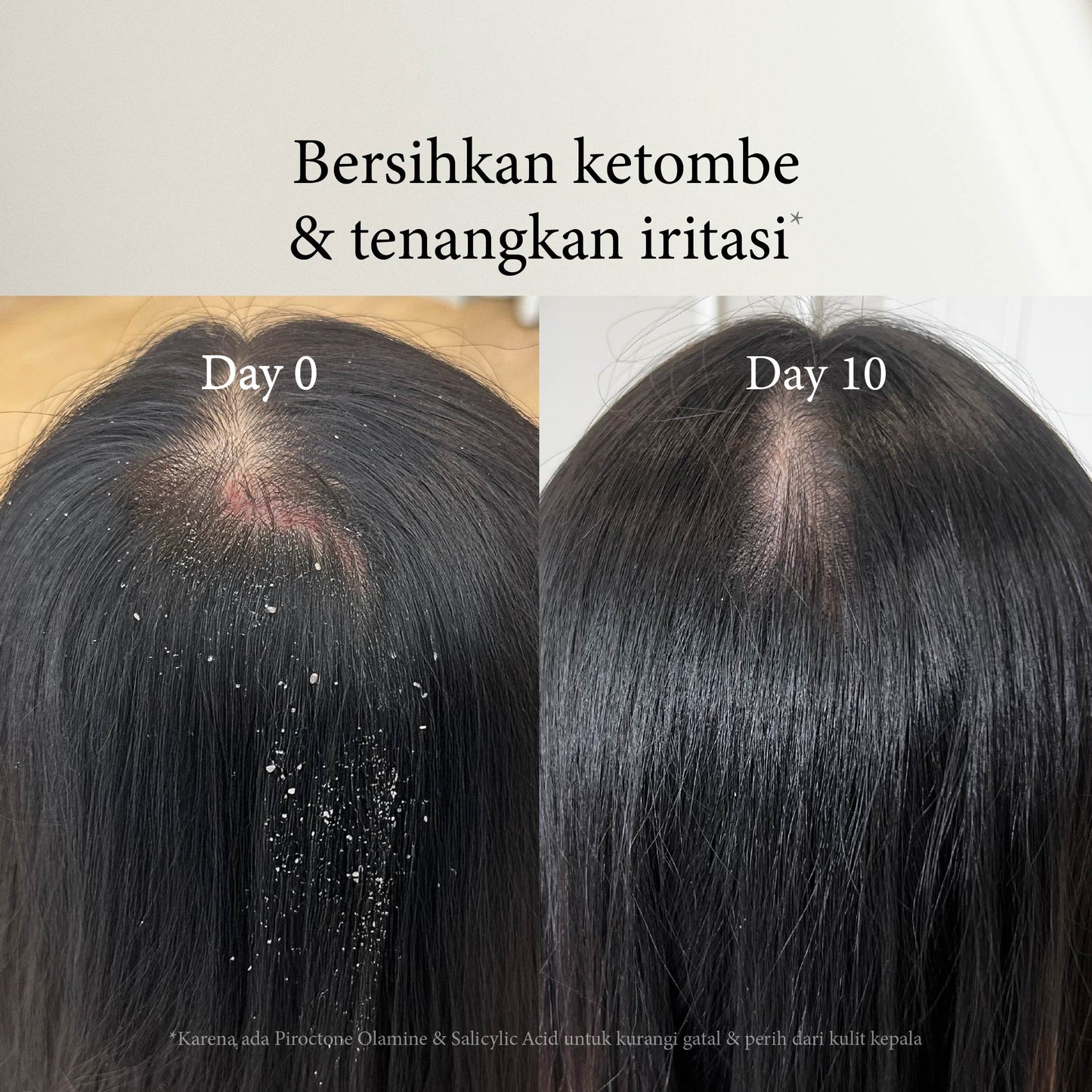 Ocean Breeze Dandruff Treatment Shampoo | Perawatan Rambut | Gatal | Ketombe Basah | Ketombe kering | Kering | Sensitive Scalp | Haircare