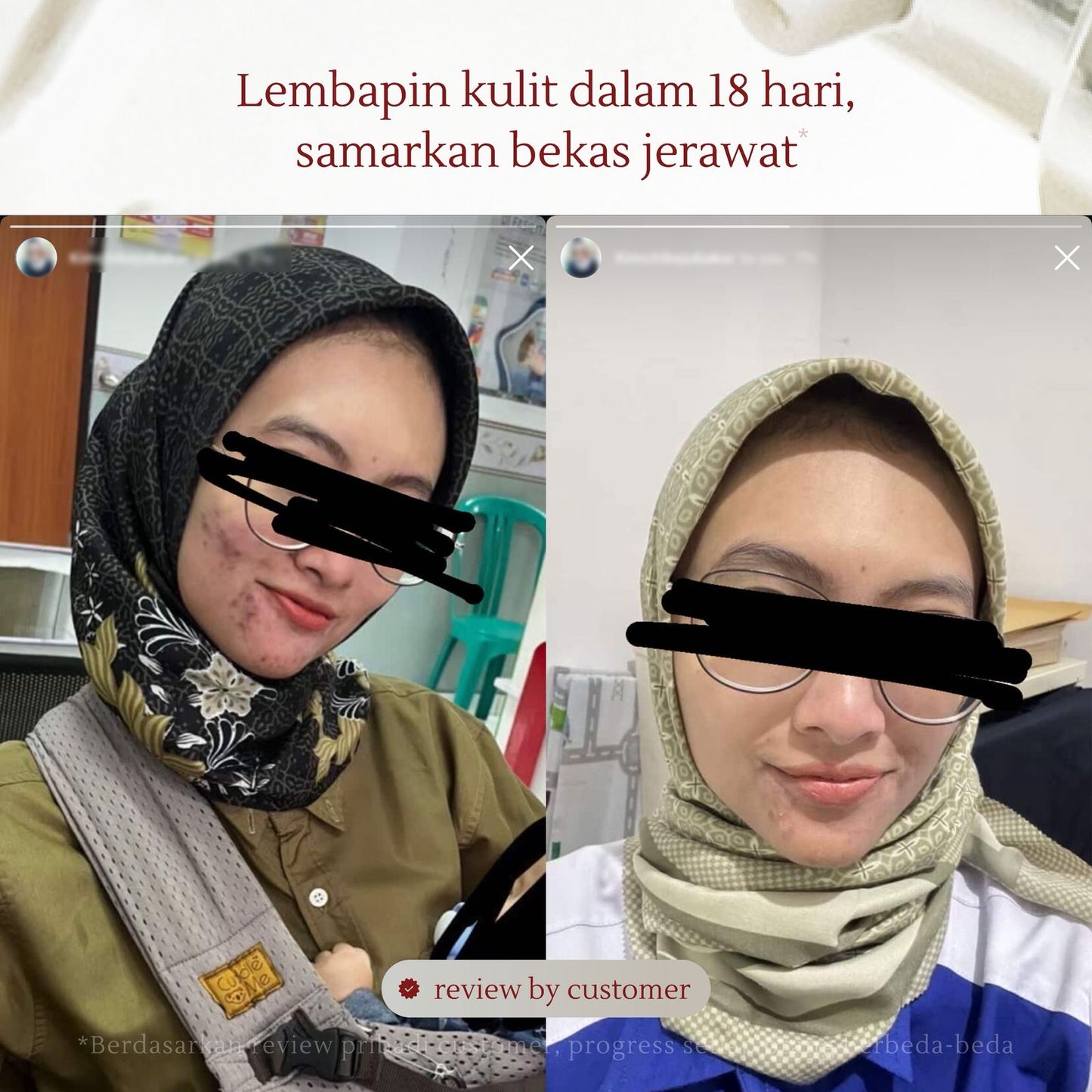 Active Acne Treatment Bundle | Rose Jelly Mask 300ml + Salicylic Acid Anti-Acne Foaming Cleanser + Salicylic Acid Acne Care Toner + Acne Care Essences