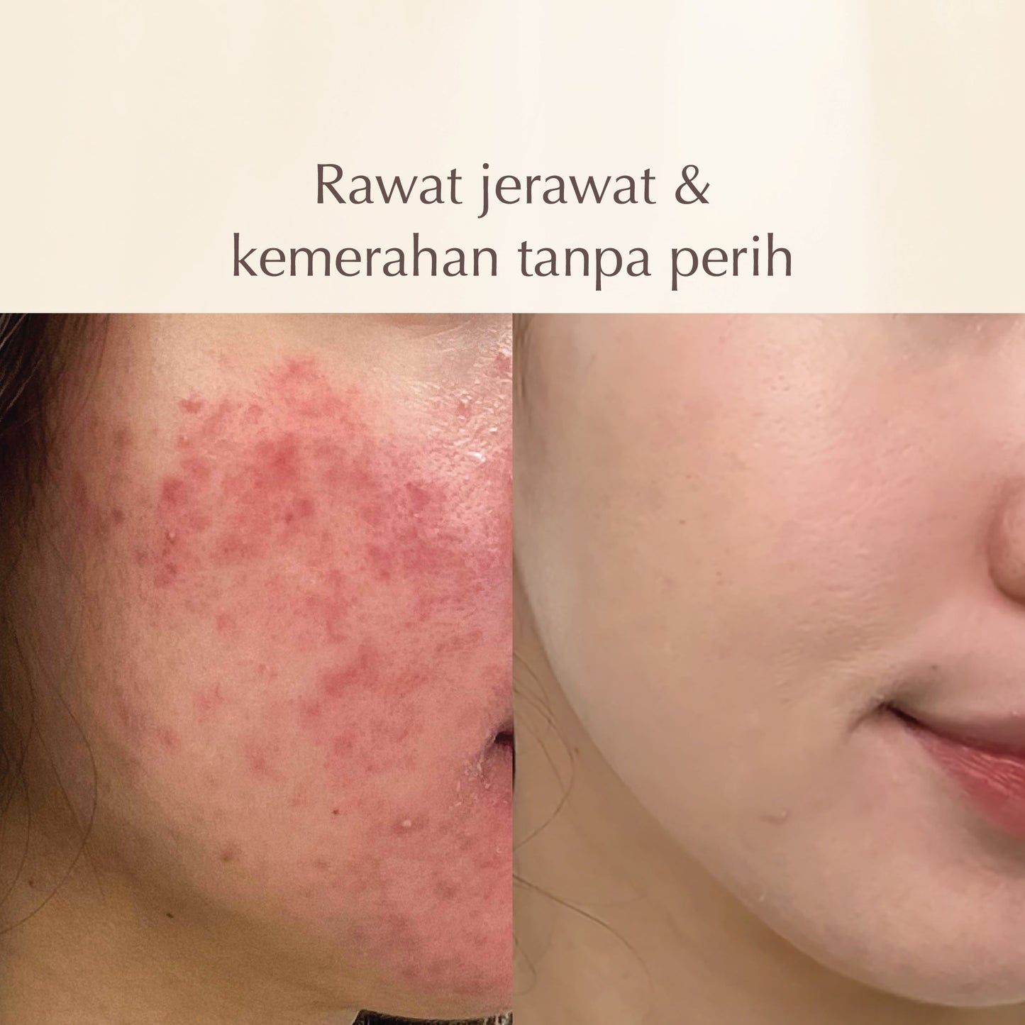 Shiconix Soothing Moisture Face Mask | Rawat Jerawat Meradang | Tenangkan kulit Kemerahan |  Kulit Sensitif dan Iritasi | Rawat Jerawat | Acne Treatment | BPOM