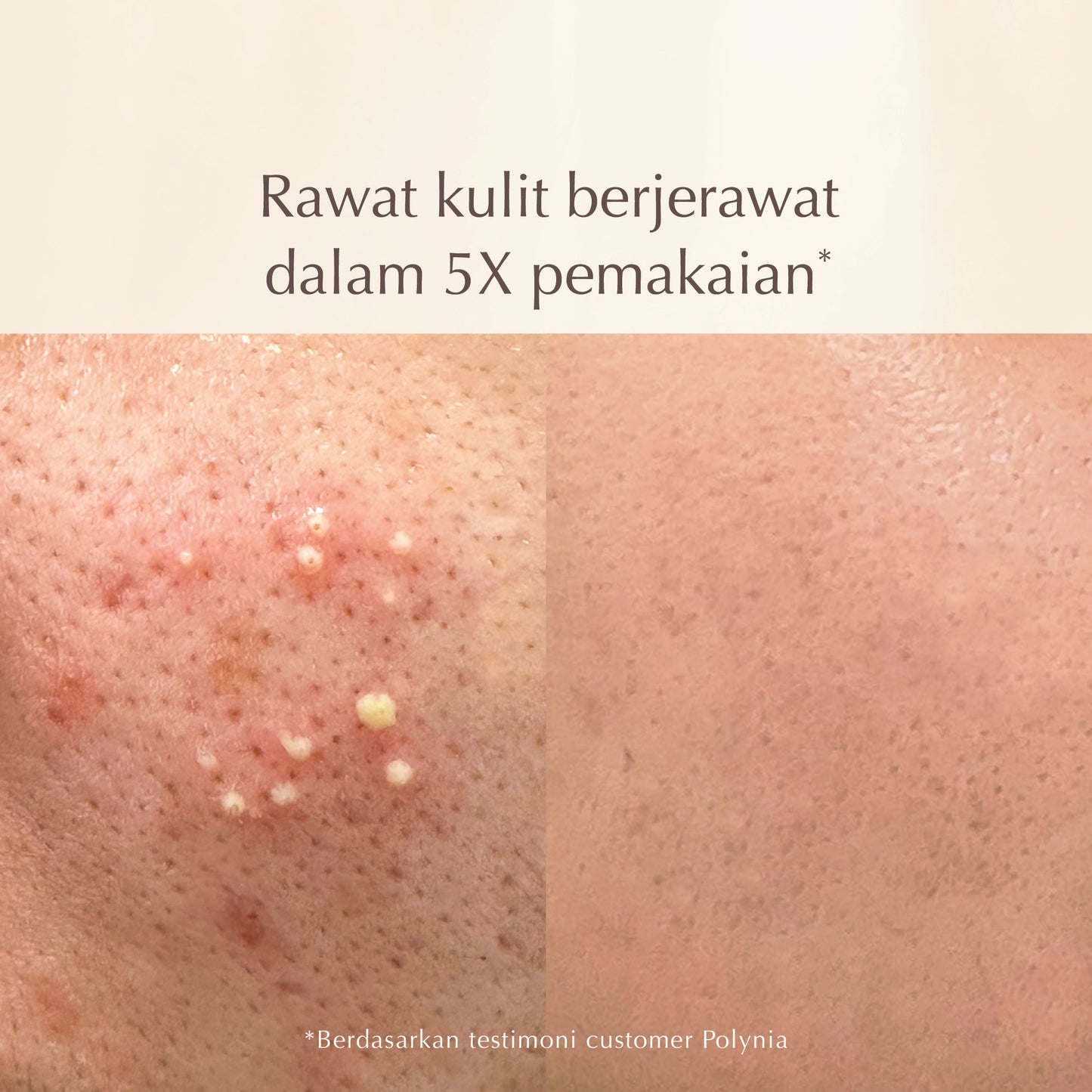 Shiconix Soothing Moisture Face Mask | Rawat Jerawat Meradang | Tenangkan kulit Kemerahan |  Kulit Sensitif dan Iritasi | Rawat Jerawat | Acne Treatment | BPOM