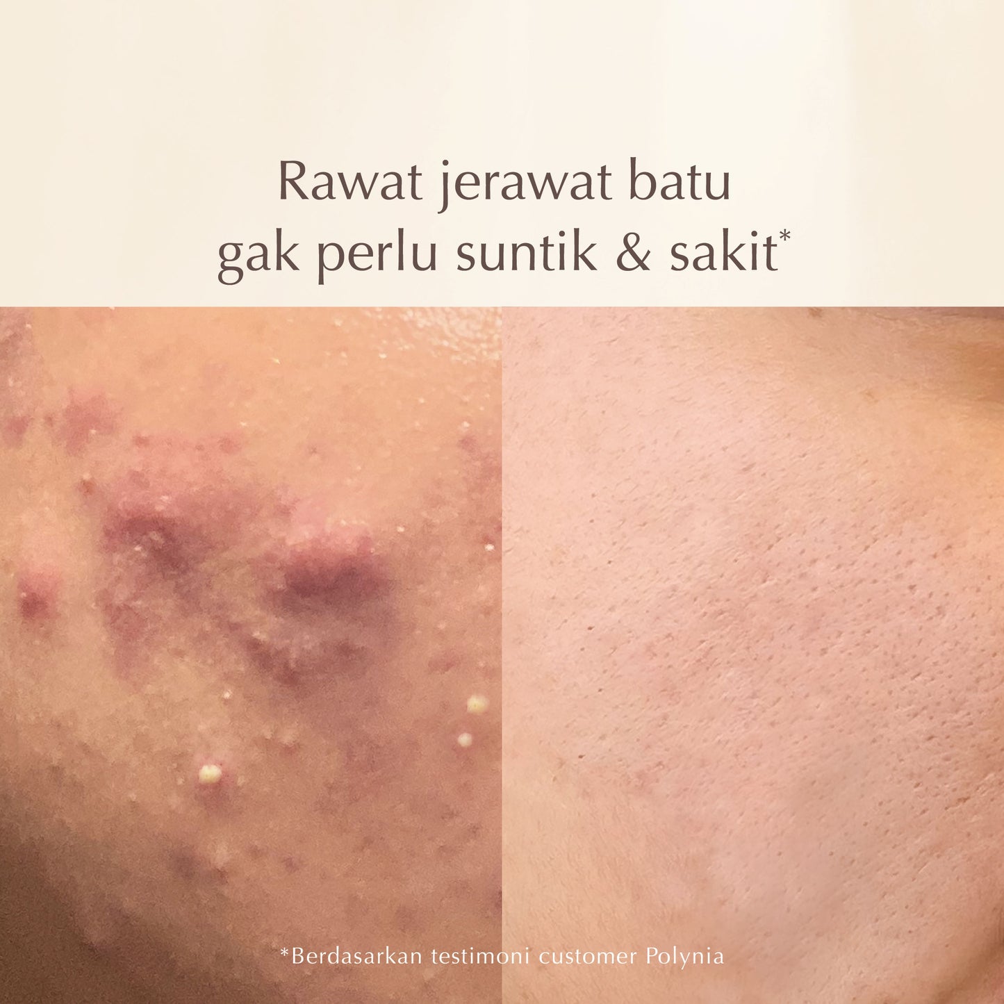 Shiconix Soothing Moisture Face Mask | Rawat Jerawat Meradang | Tenangkan kulit Kemerahan |  Kulit Sensitif dan Iritasi | Rawat Jerawat | Acne Treatment | BPOM