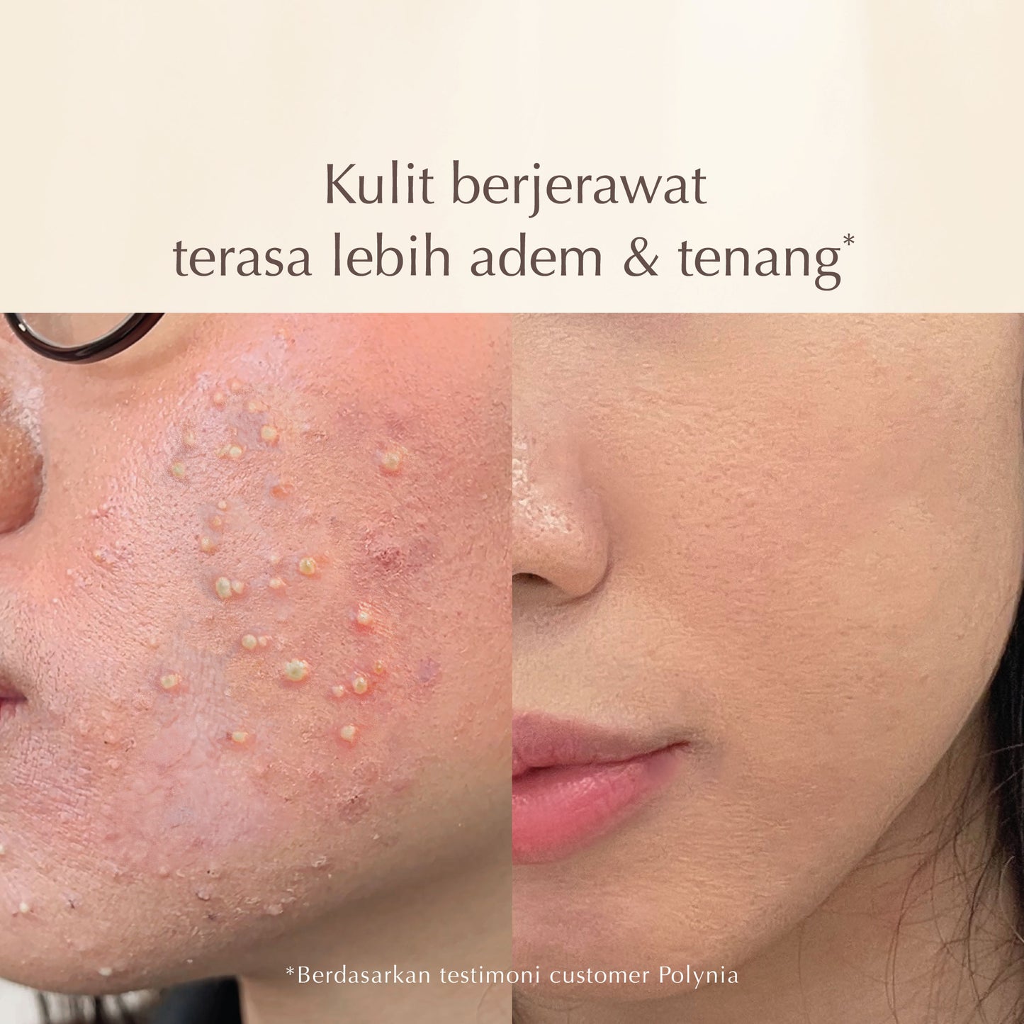 Shiconix Soothing Moisture Face Mask | Rawat Jerawat Meradang | Tenangkan kulit Kemerahan |  Kulit Sensitif dan Iritasi | Rawat Jerawat | Acne Treatment | BPOM